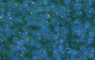 Células de linfoma marcadas con fluorescencia.